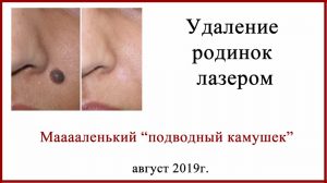Удаляем родинку лазером