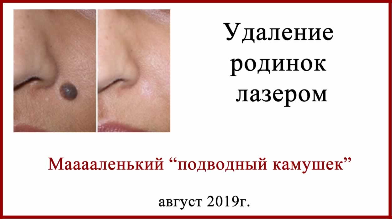 Удаляем родинку лазером Удаляем родинку лазером