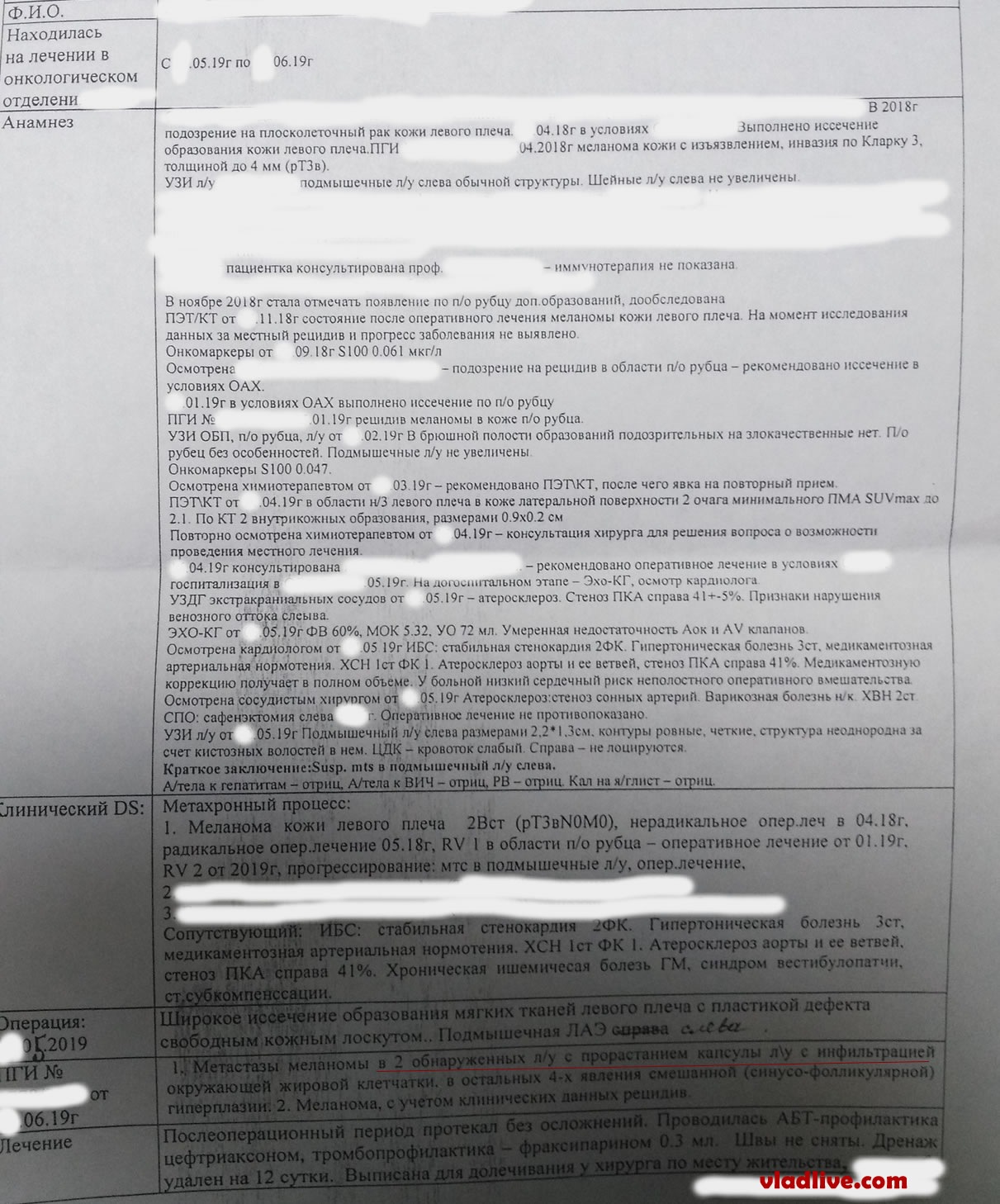 Лечение меланомы в России.