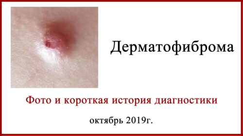 Меланома vs Дерматофиброма, или снова про диагностику по фото Дерматофиброма. Фото