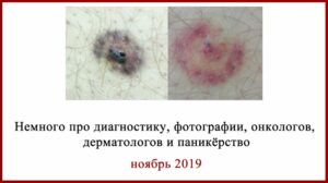 Диагностика меланомы по фото. Меланома, кератома или ...
