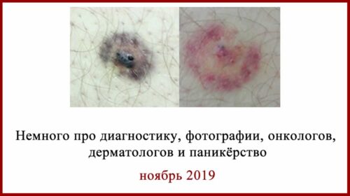 Диагностика меланомы по фото. Меланома, кератома или ...