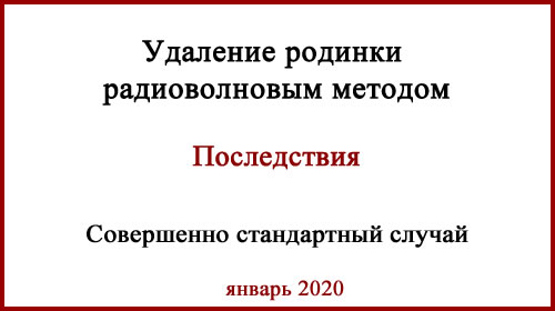 Удаление родинки радиоволновым методом