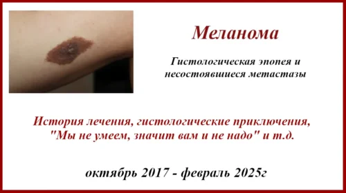 Меланома история лечения