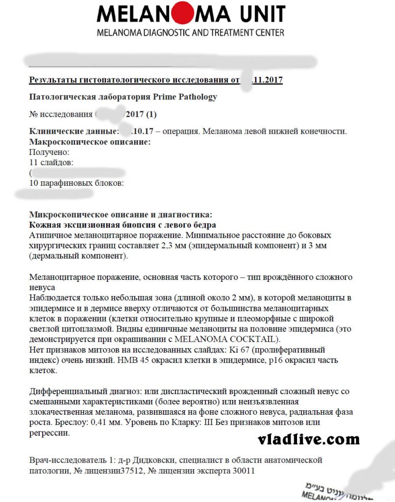 Меланома история лечения - Пересмотр гистологии в Израиле
