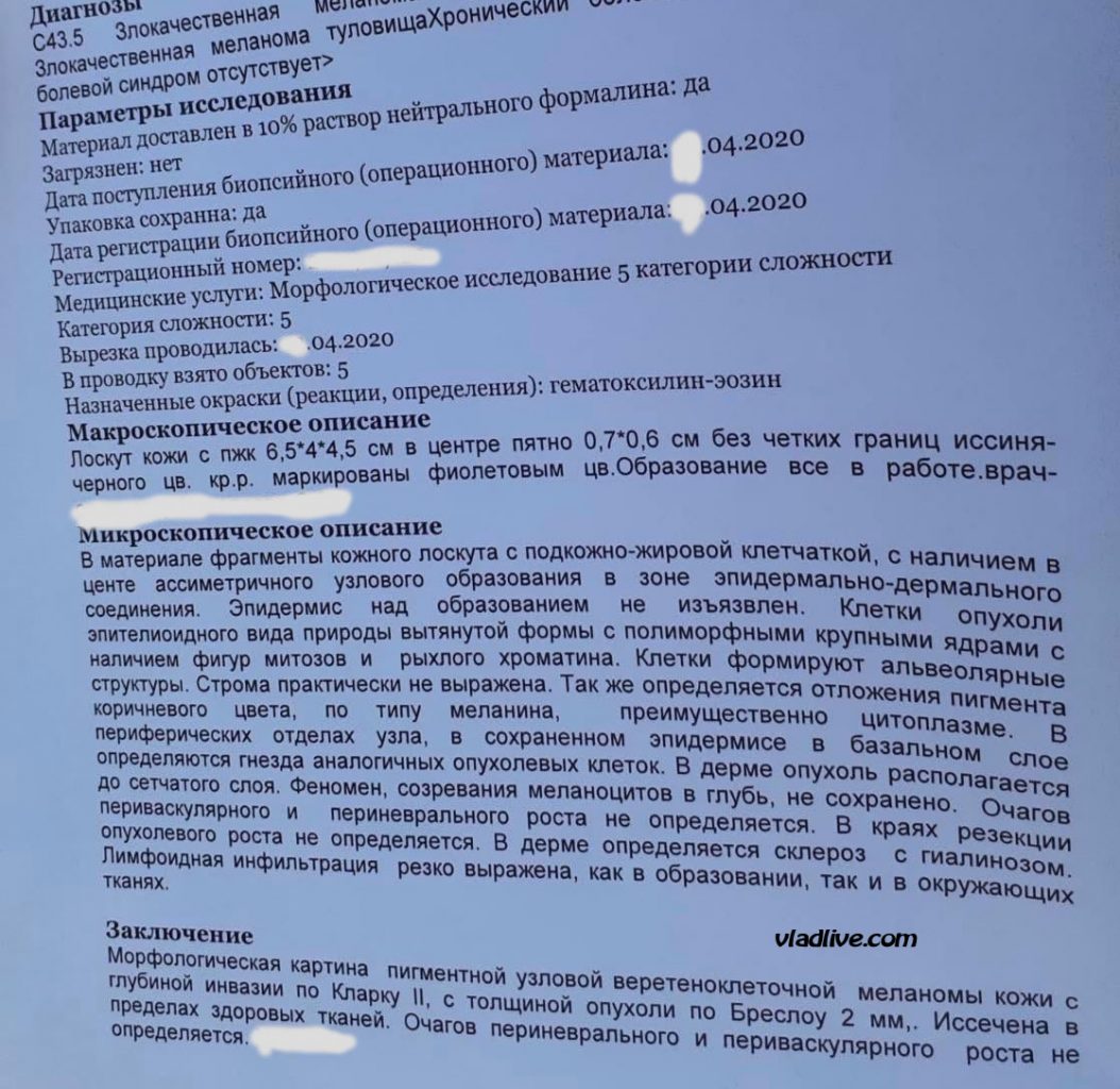 Меланома гистология