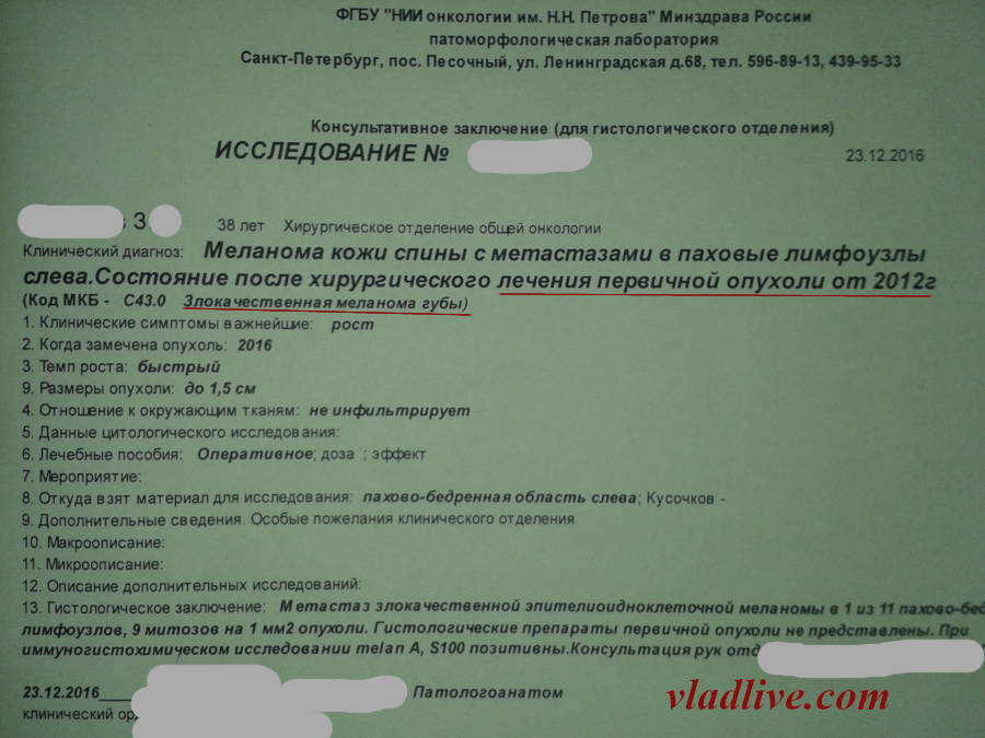 Меланома 0.6 мм по Бреслоу. Метастаз в лимфоузел.