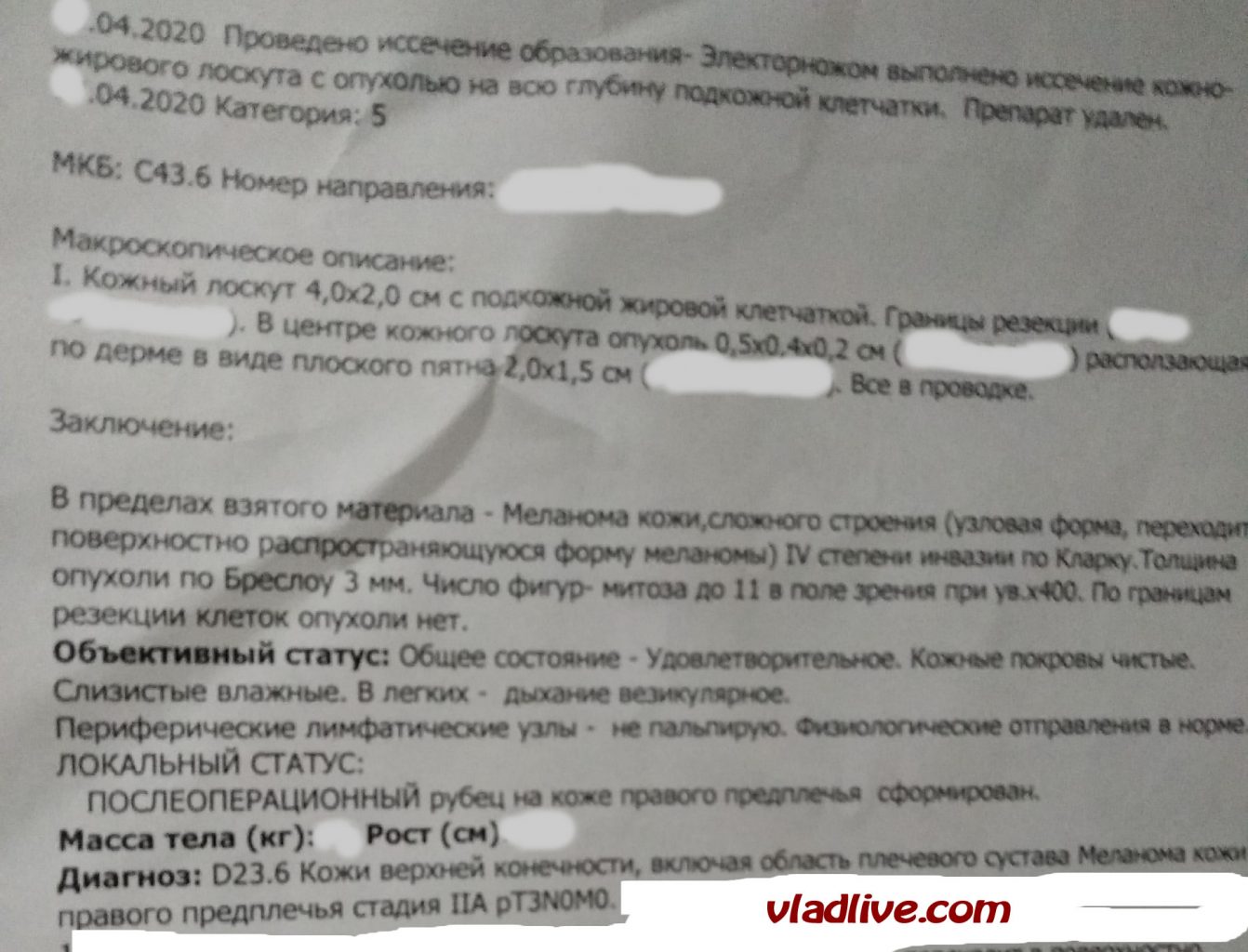 История лечения меланомы. Гистология №1