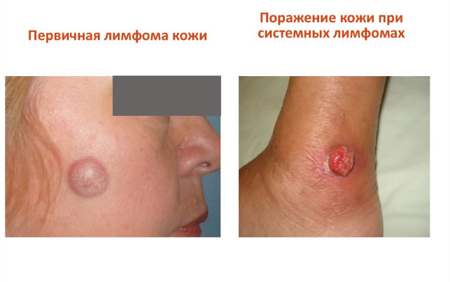 Лимфома на коже