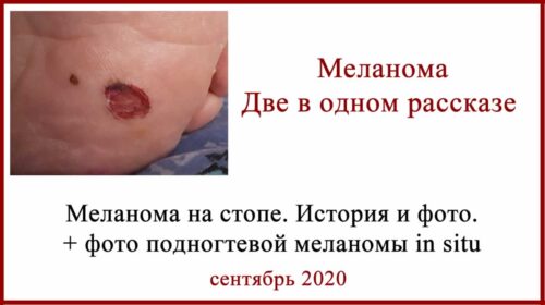 Меланома на стопе. Рассказ и фото