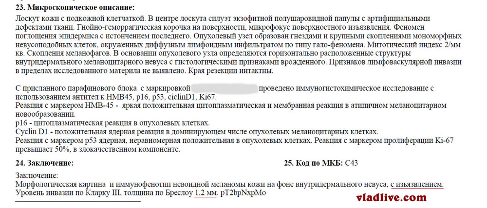 Меланома ИГХ