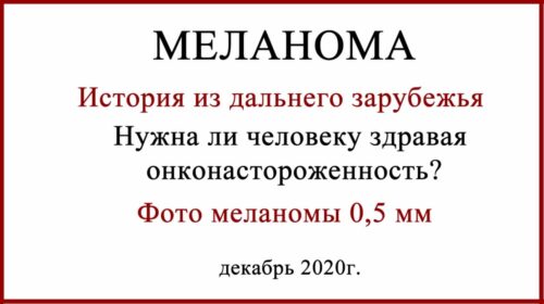 Фото меланомы 0.5 мм. История из Америки