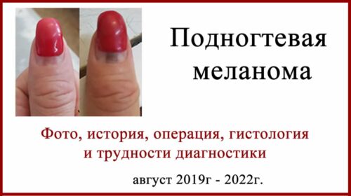 Подногтевая меланома. Выявление, лечение, итоги