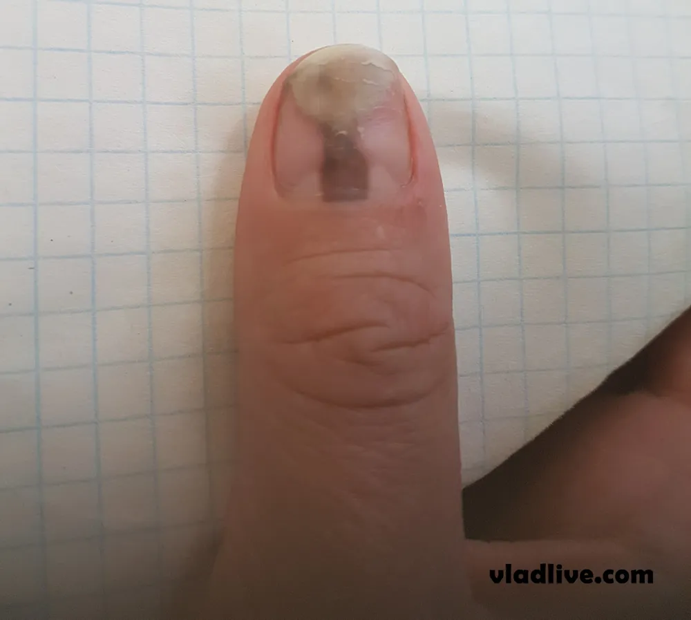 Фото подногтевой меланомы