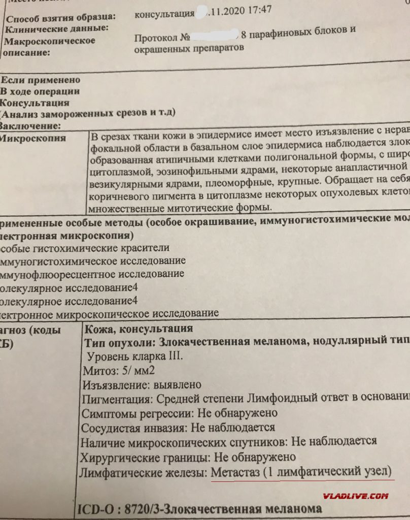 Меланома. Метастаз в лимфоузле