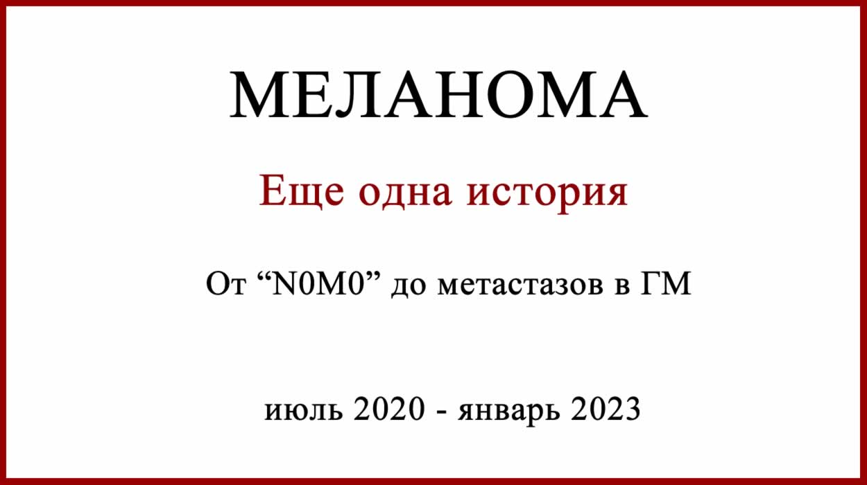 Еще одна история лечения меланомы. История лечения меланомы 2020-2023