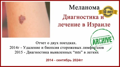 Лечение меланомы в Израиле. 10 лет после операции