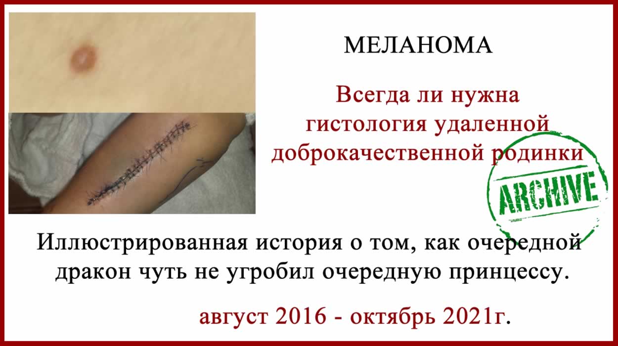 Зачем сдавать родинки на гистологию? Зачем сдавать родинки на гистологию?