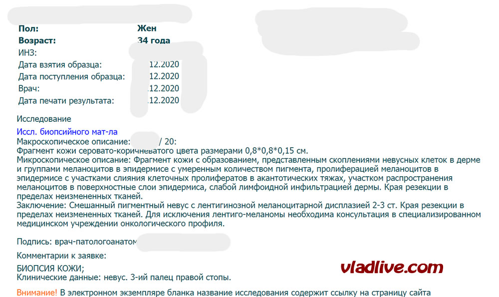Ошибки гистологии меланомы