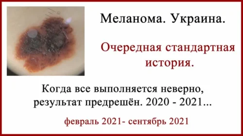 Лечение меланомы в Украине. Стандартно и печально