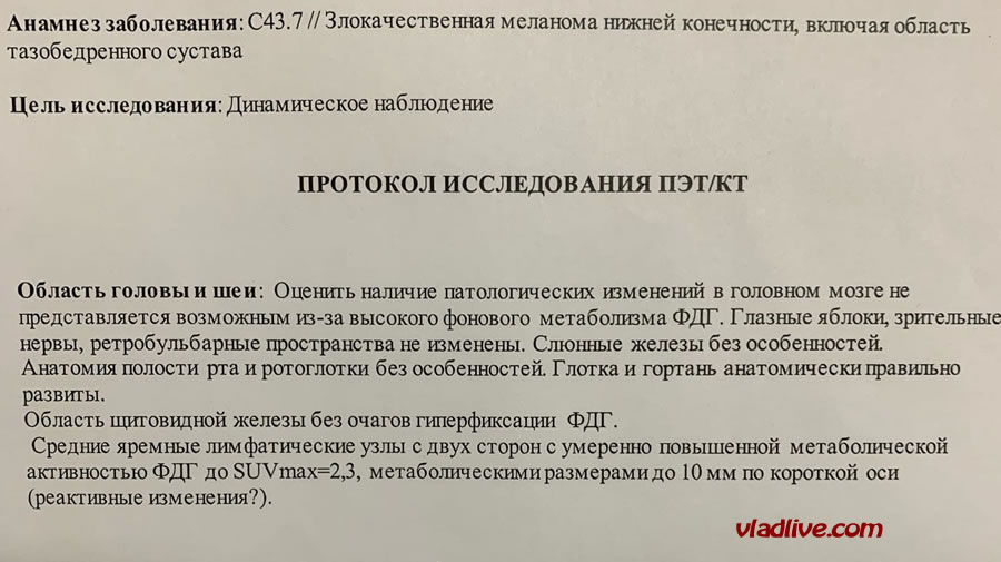 Меланома 4 мм по Бреслоу. Увеличенные лимфоузлы