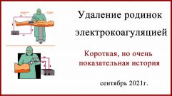 Удаление родинок электрокоагуляцией