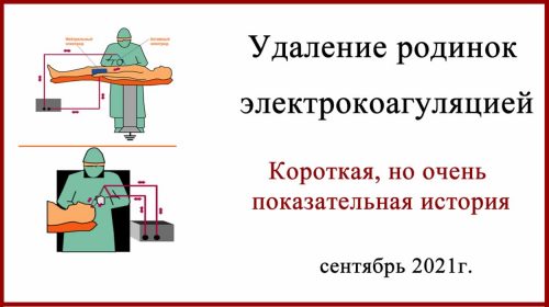 Удаление родинок электрокоагуляцией