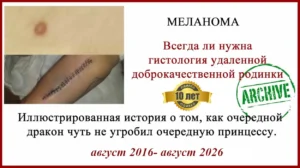Зачем сдавать родинки на гистологию? История лечения меланомы III стадии