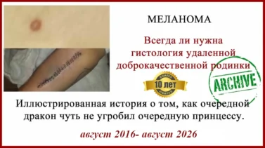 Зачем сдавать родинки на гистологию? История лечения меланомы III стадии