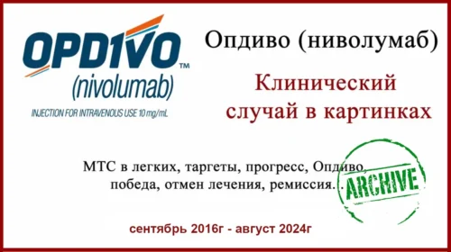 Опдиво (ниволумаб) в лечении меланомы. Полный ответ и результат через 5,5 лет