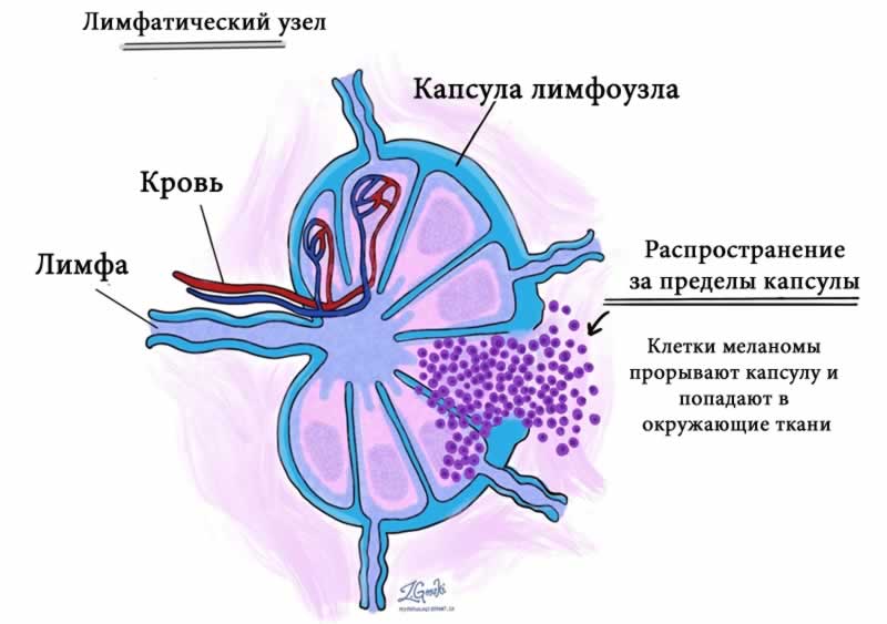 Распространение метастазов за пределы капсулы лимфоузла