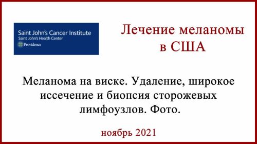 Меланома на виске. Лечение