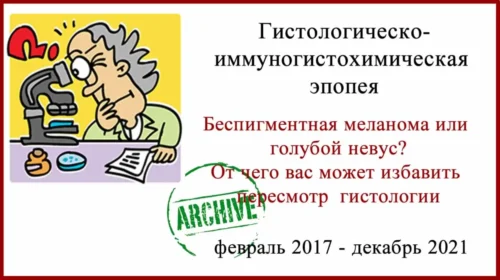 Беспигментная меланома или голубой невус? Гистология и лечение в Израиле