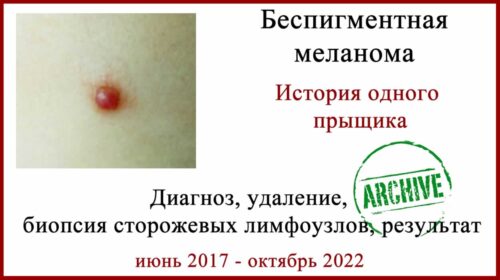 Беспигментная меланома. Диагноз, фото, лечение, результат через 5 лет