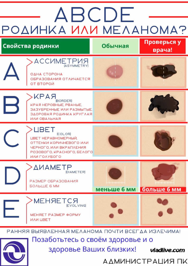 Родинка или меланома?