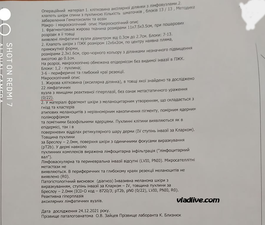 Лимфодиссекция при меланоме