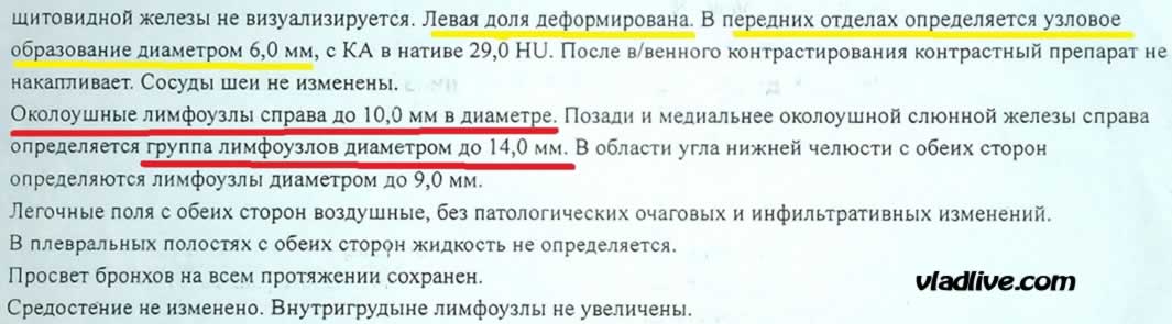 Рак щитовидной железы