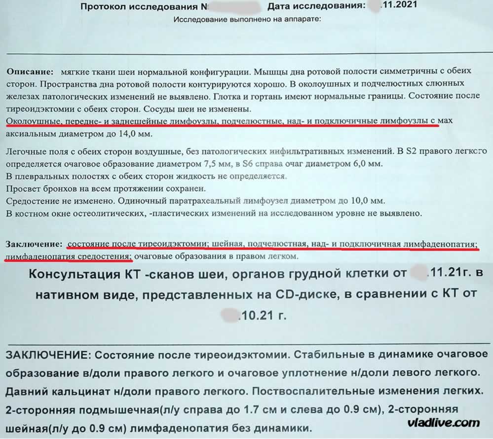 Меланома и рак щитовидной железы. Результаты КТ