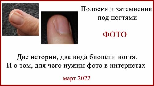 Биопсия ногтя. Фото, истории.