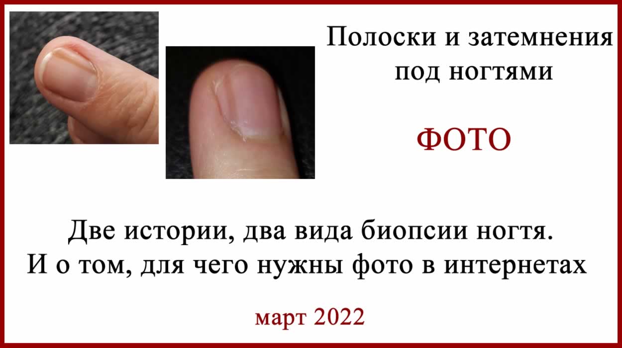 Биопсия ногтя. Полоски и затемнения. Фото Биопсия ногтя. Фото, истории.
