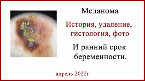 Лечение меланомы на шее