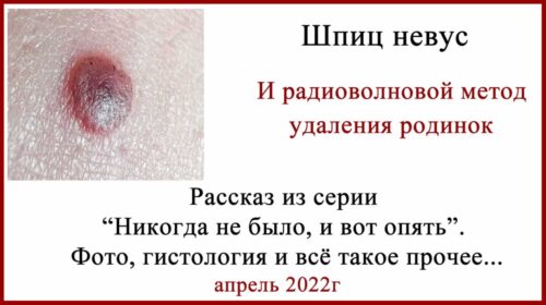 Шпиц невус и удаление родинок радиоволновым методом - сургитроном