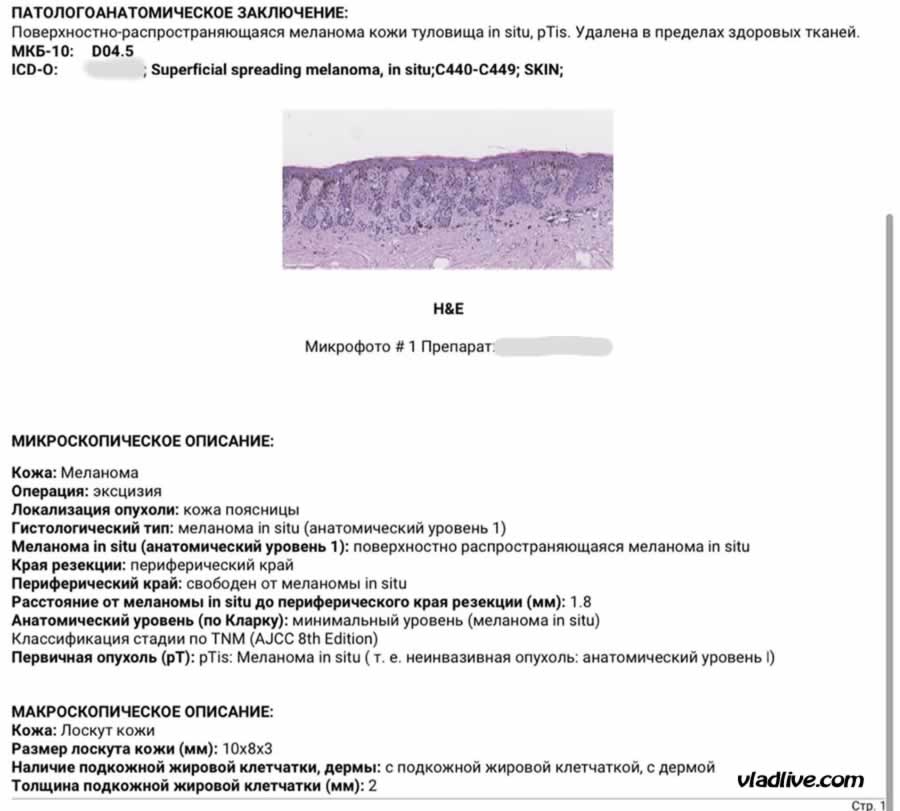 Гистология меланомы in situ