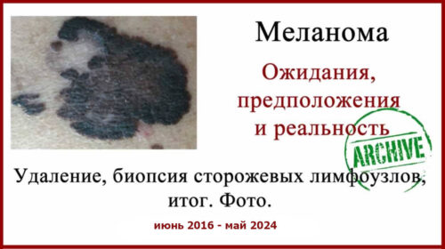 Меланома 0.3 мм с регрессом. Лечение меланомы в Израиле. Прошло 8 лет. Диагностика в Тель-Авиве
