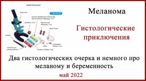 Меланома беременность и гистология