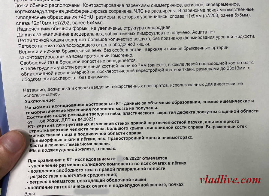 Меланома слизистой. КТ. Метастазы