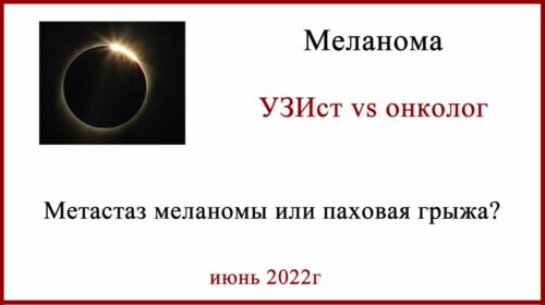 Метастаз в лимфоузел или грыжа?