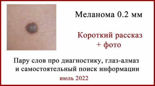 Меланома. 0,2 мм по Бреслоу. История