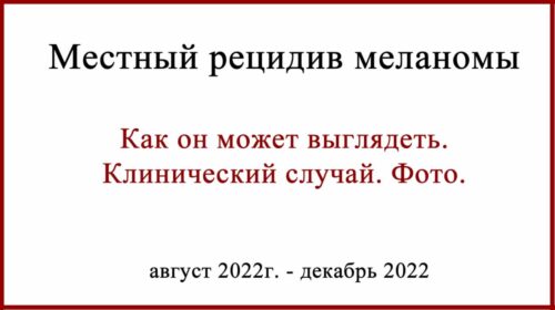 Местный рецидив меланомы. Клинический случай и фото.