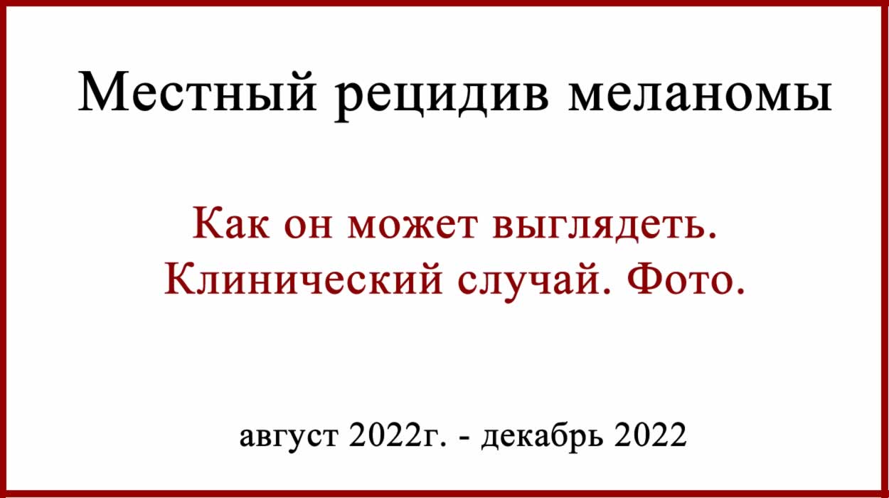 Местный рецидив меланомы. Клинический случай и фото.